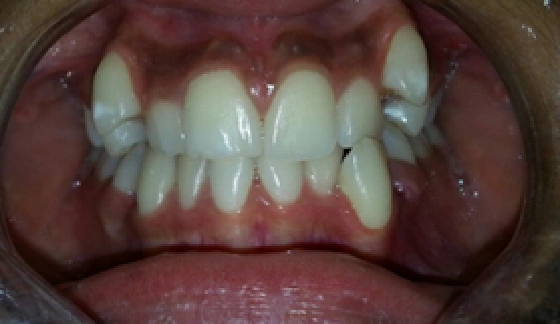 Ortho Braces – before